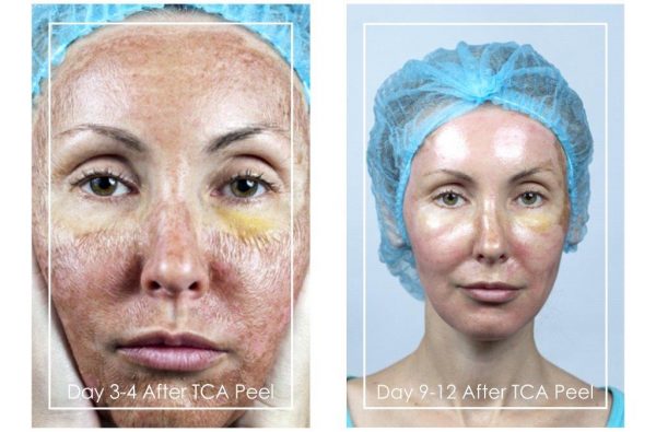 Chemical Skin Peels, Before & After - Dr Ria Smit