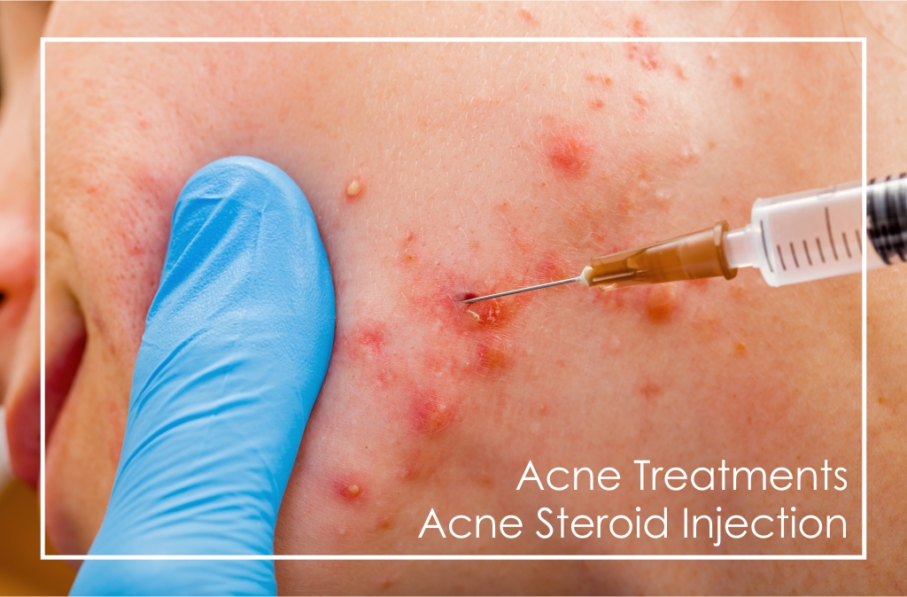 Dr Ria Smit Women's Health & Aesthetic Medicine, Paarl Acne treatment Steroid Injection