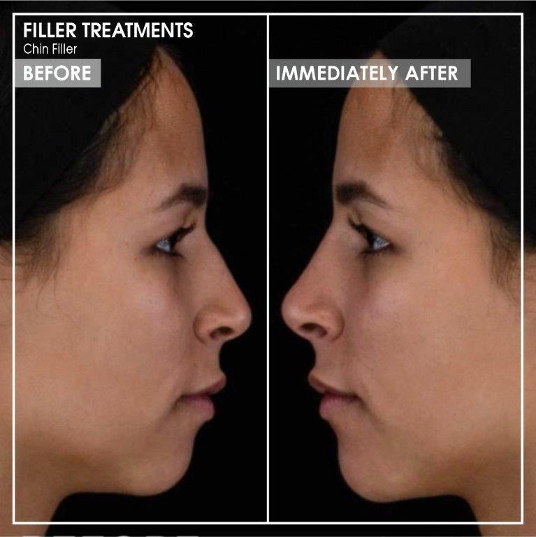 Dr Ria Smit Aesthetics_Chin Filler Treatments Before and Immediately After Pictures