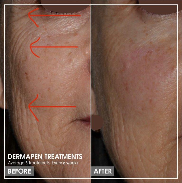 Dr Ria Smit Aesthetics_Dermapen Treatment Before and After Pictures