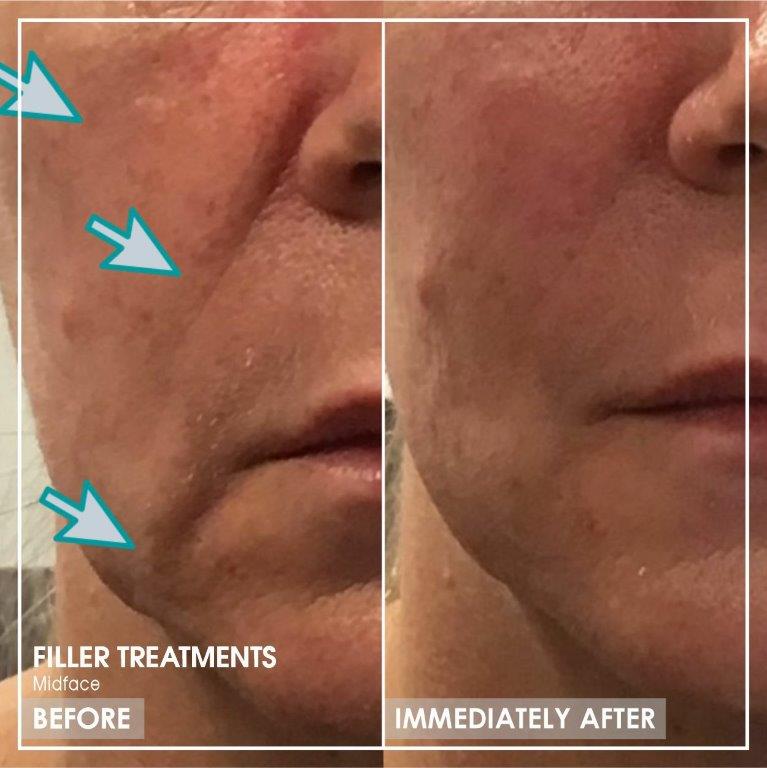 Dr Ria Smit Aesthetics_Midface Filler Treatments Before Immediately After Pictures