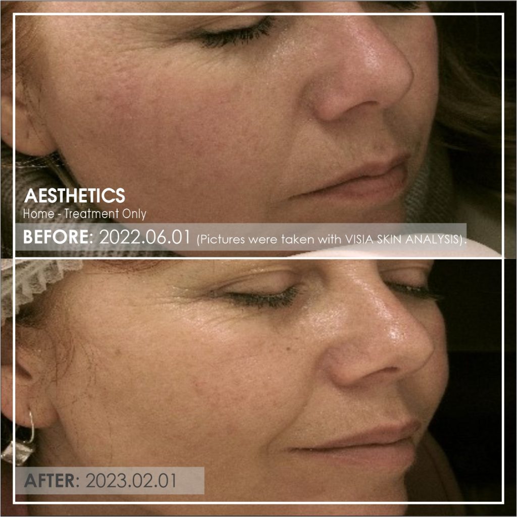 Rosacea Home Treatment Before After Dr Ria Smit Paarl Before treatment pictures = JUNE 2022. After treatment pictures = FEBRUARY 2023. Treatment ONLY with Home care. Pictures were taken with Visa Skin Analysis